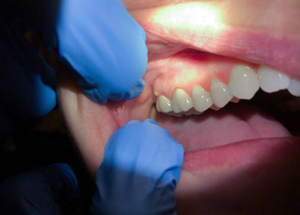 Best Emergency Treatment for Dental Infections or Abscesses in Yorkvle, IL